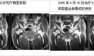 针刀松解治疗股骨头坏死的机理探讨和典型病例影像报告